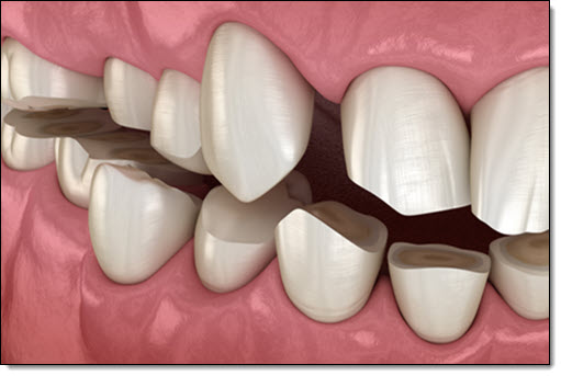 Bruxism