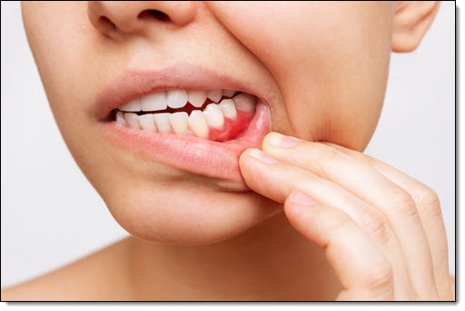 Gum Disease