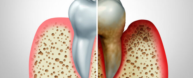 Gum Disease