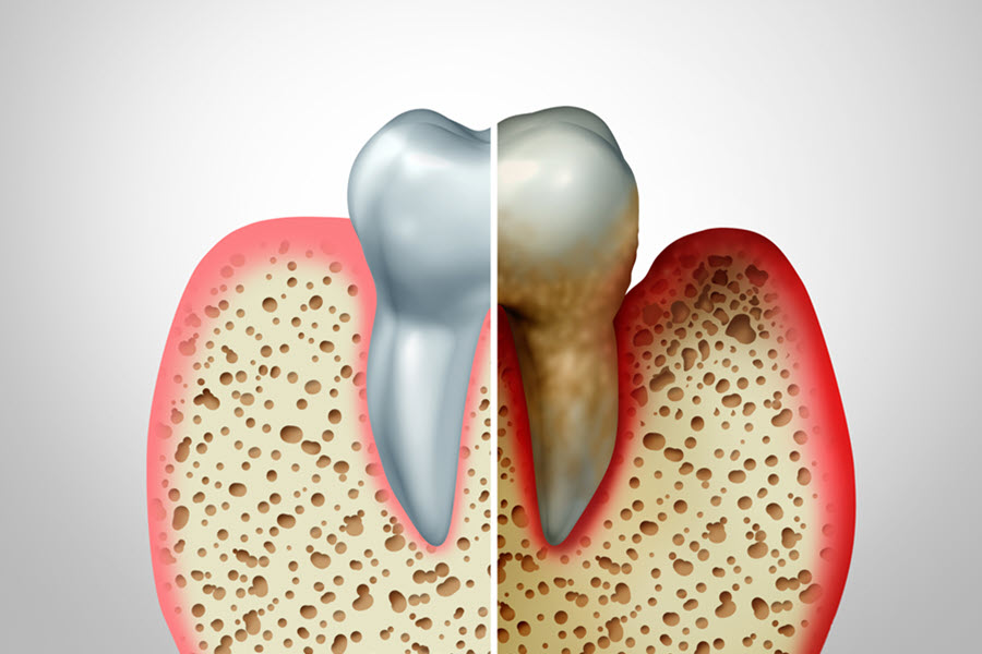 Gum Disease