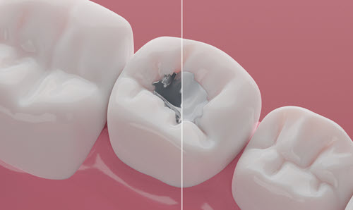 Composite Fillings