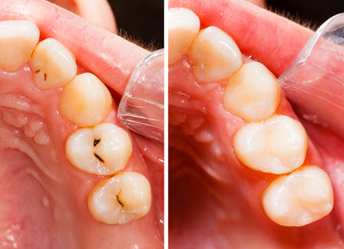 Composite Fillings