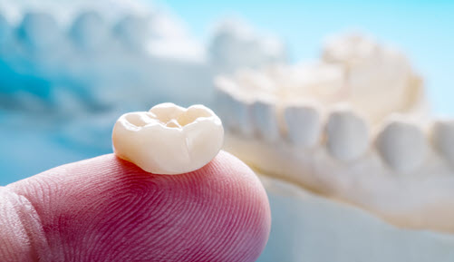 Dental Crowns