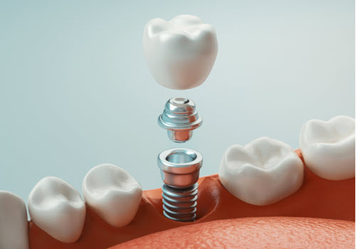 Dental Implants