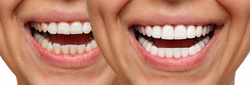 Dental Veneers