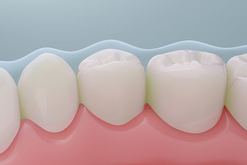 Fluoride Treatments