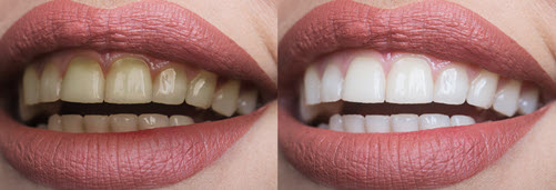 Teeth Whitening