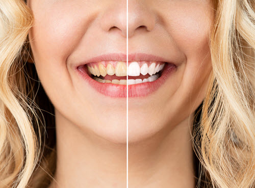 Whitening