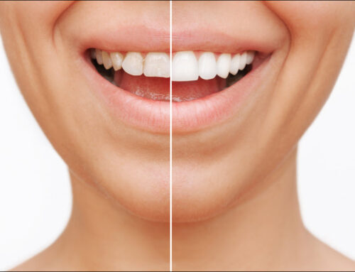 The Rise of Smile Enhancement Procedures