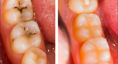 Dental Filling